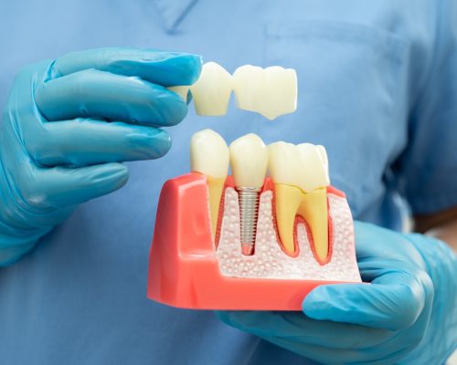 tooth replacement options